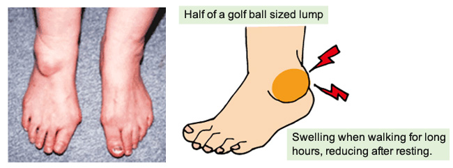 Bulge on the lateral malleolus (outside of the ankle) | KASAHARA FOOT CARE