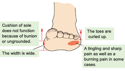 Stabbing pain on the fourth toe (Morton 
