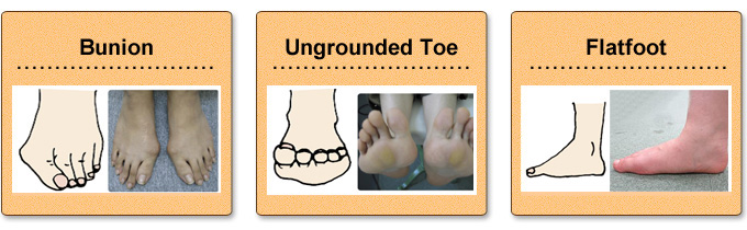 bunion.ungrounded tor.flatfoot